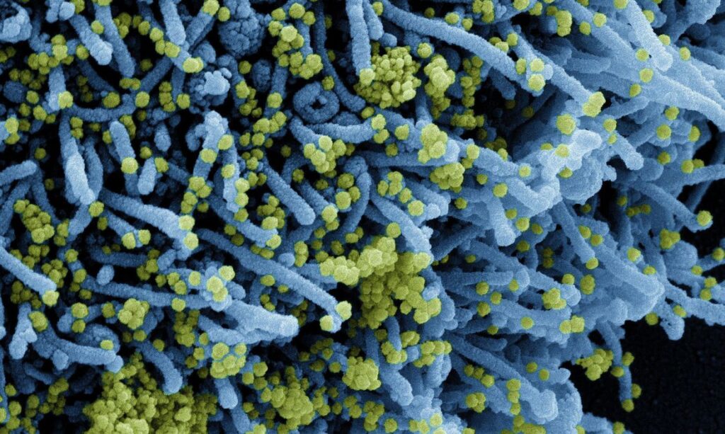 Novo Coronavírus SARS-CoV-2 Micrografia eletrônica de varredura colorida de uma célula infectada com uma cepa variante de partículas do vírus SARS-CoV-2 (laranja), isolada de uma amostra de paciente. © National Institute of Allergy and Infectious Diseases/NIAID/Direitos reservados